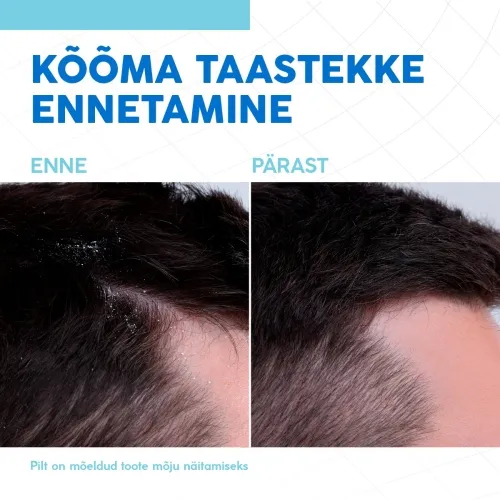 NIZORAL CARE SHAMPOON KUIVALE JA TUNDLIKULE PEANAHALE 200ML - Tootepilt 3